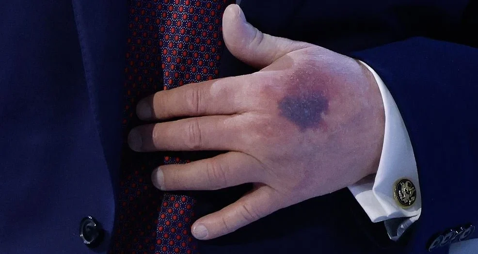 Bruise on Donald Trump’s Left Hand Sparks Health Speculation at Davos