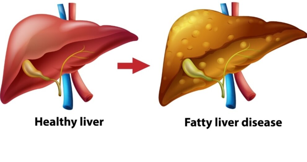 Fatty Liver Is Not Harmless Experts Warn About Risk of Cirrhosis and Cancer