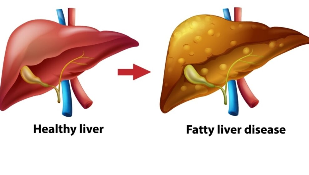 Fatty Liver Is Not Harmless Experts Warn About Risk of Cirrhosis and Cancer