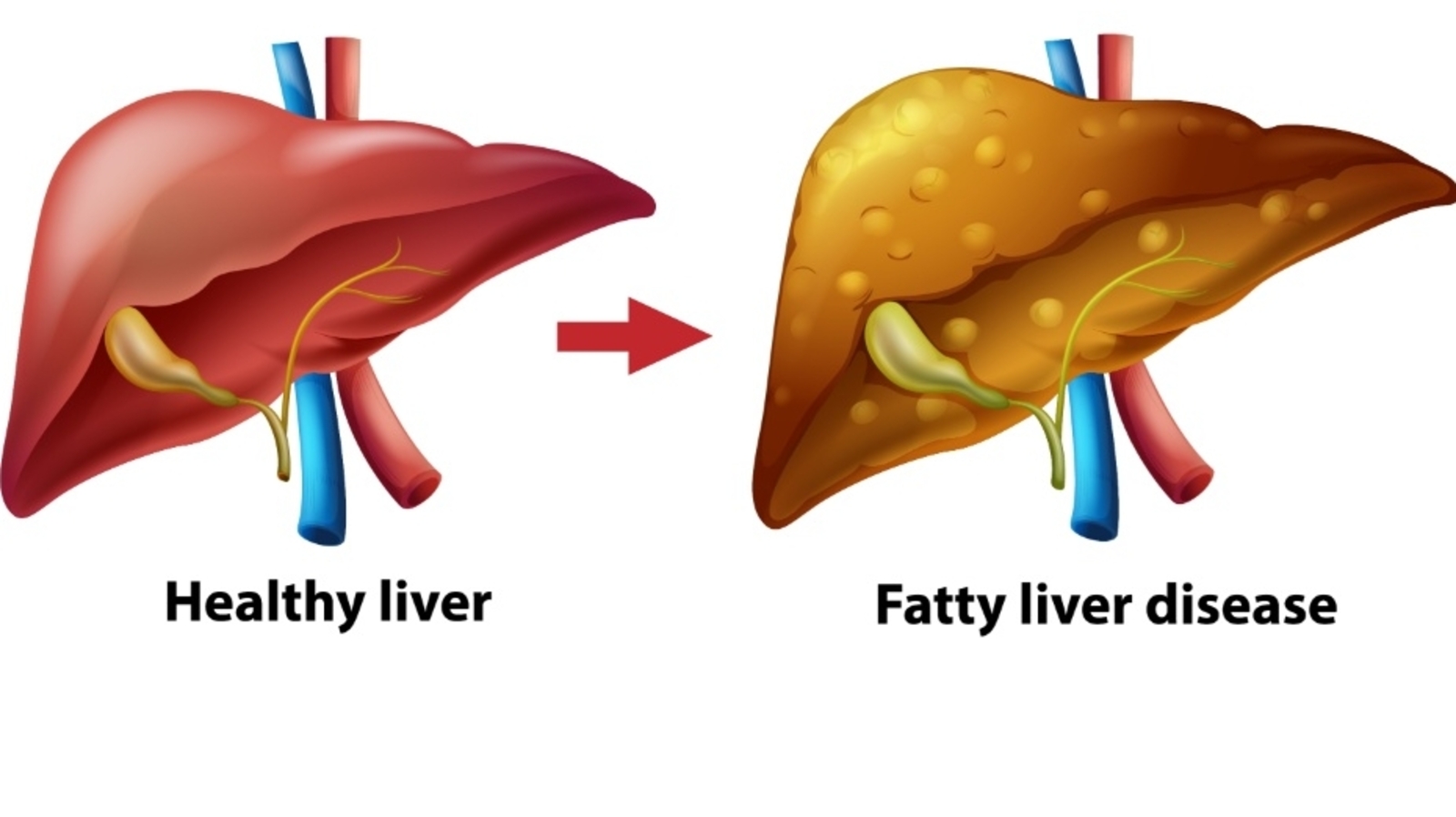 Fatty Liver Is Not Harmless Experts Warn About Risk of Cirrhosis and Cancer